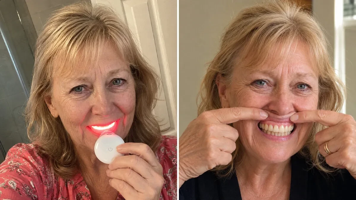 My 90-Day “Keep Your Teeth” Guarantee